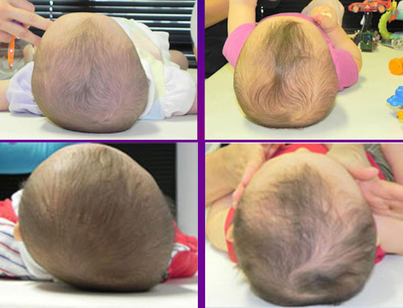 assimetrias-cranianas-em-bebês-antes e depois 0