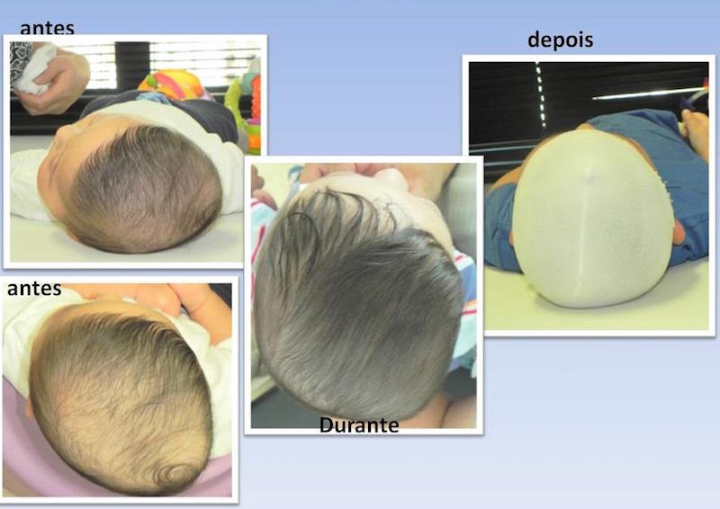 assimetrias-cranianas-em-bebês-antes e depois