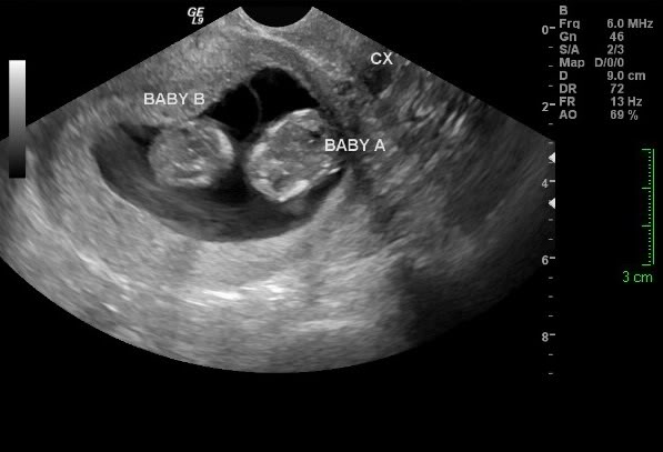 Gêmeos! Imagem: Babycenter