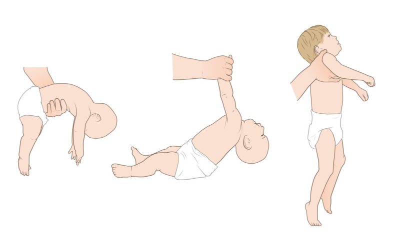 saiba mais sobre floppy baby e AME