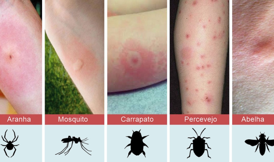 dicas sobre picadas de insetos